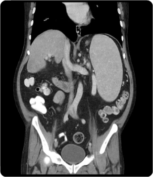  Pelvis CT Scan