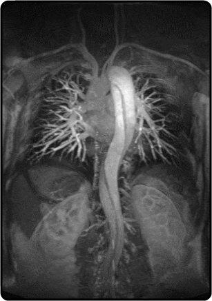 Thoracic CT Scan