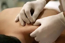 Dry Needling.jpeg