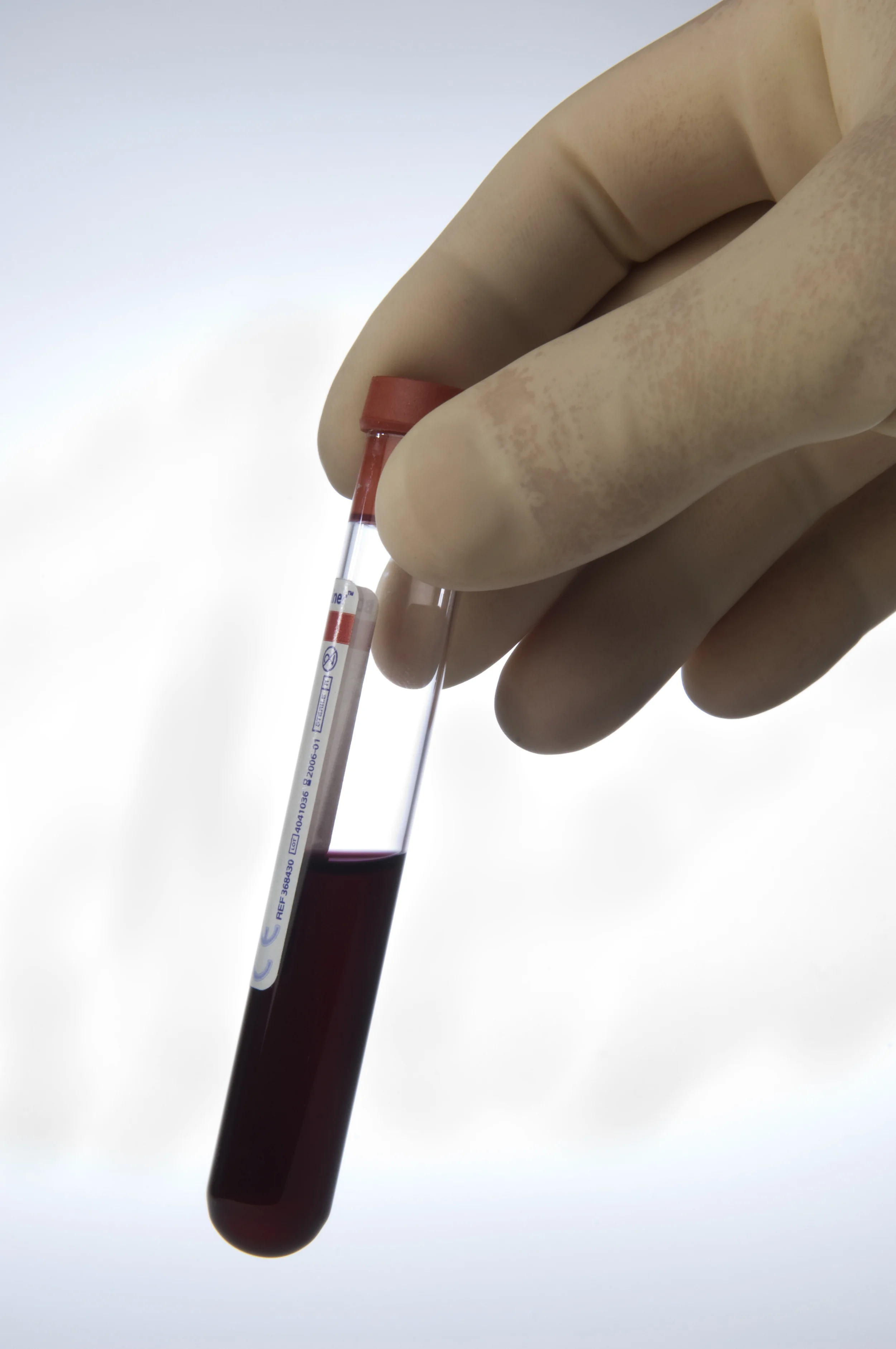 State Must Obtain Warrant Before Requiring Alcohol Blood Tests at Hospital - DUI News - 4/28/2016