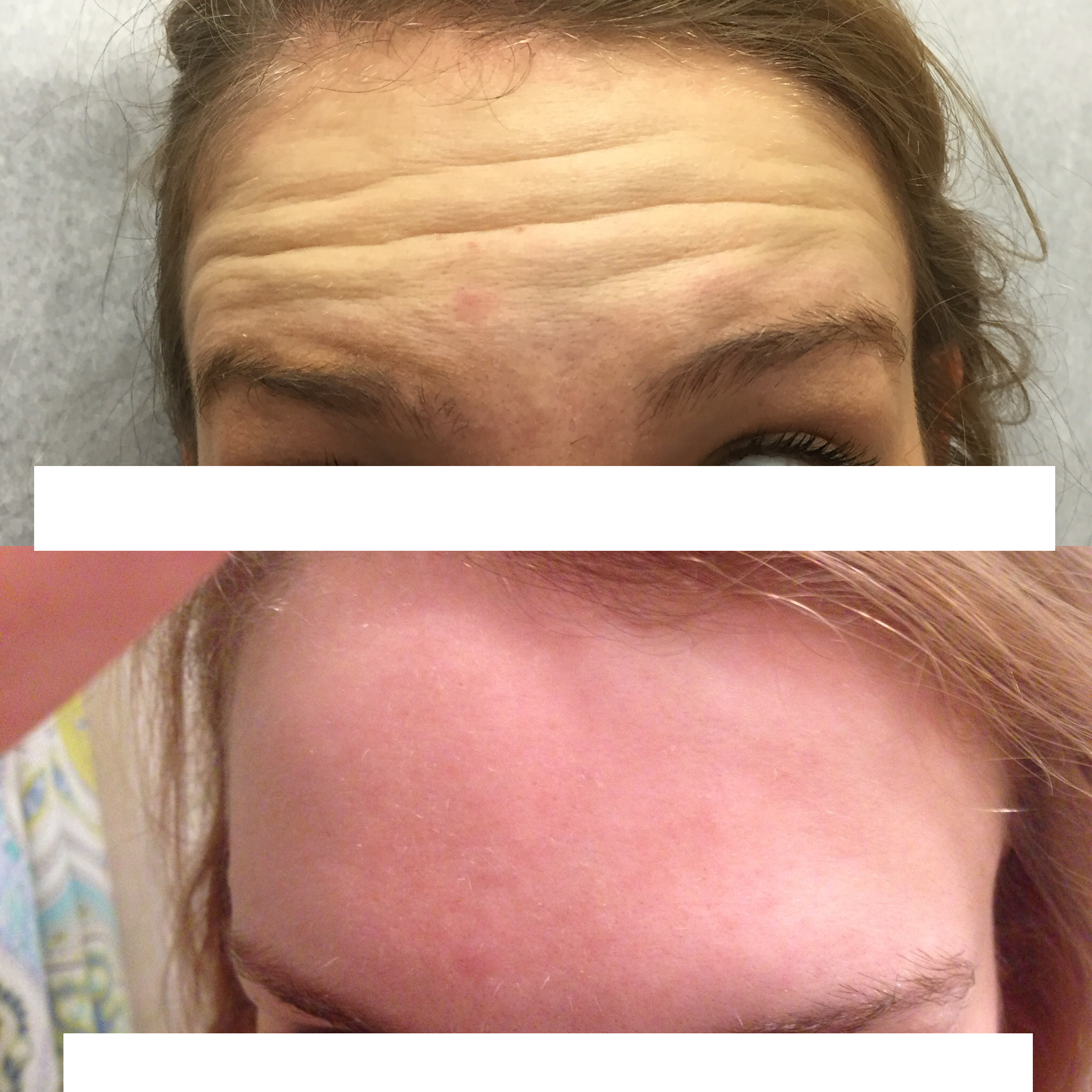 Botox Before & After