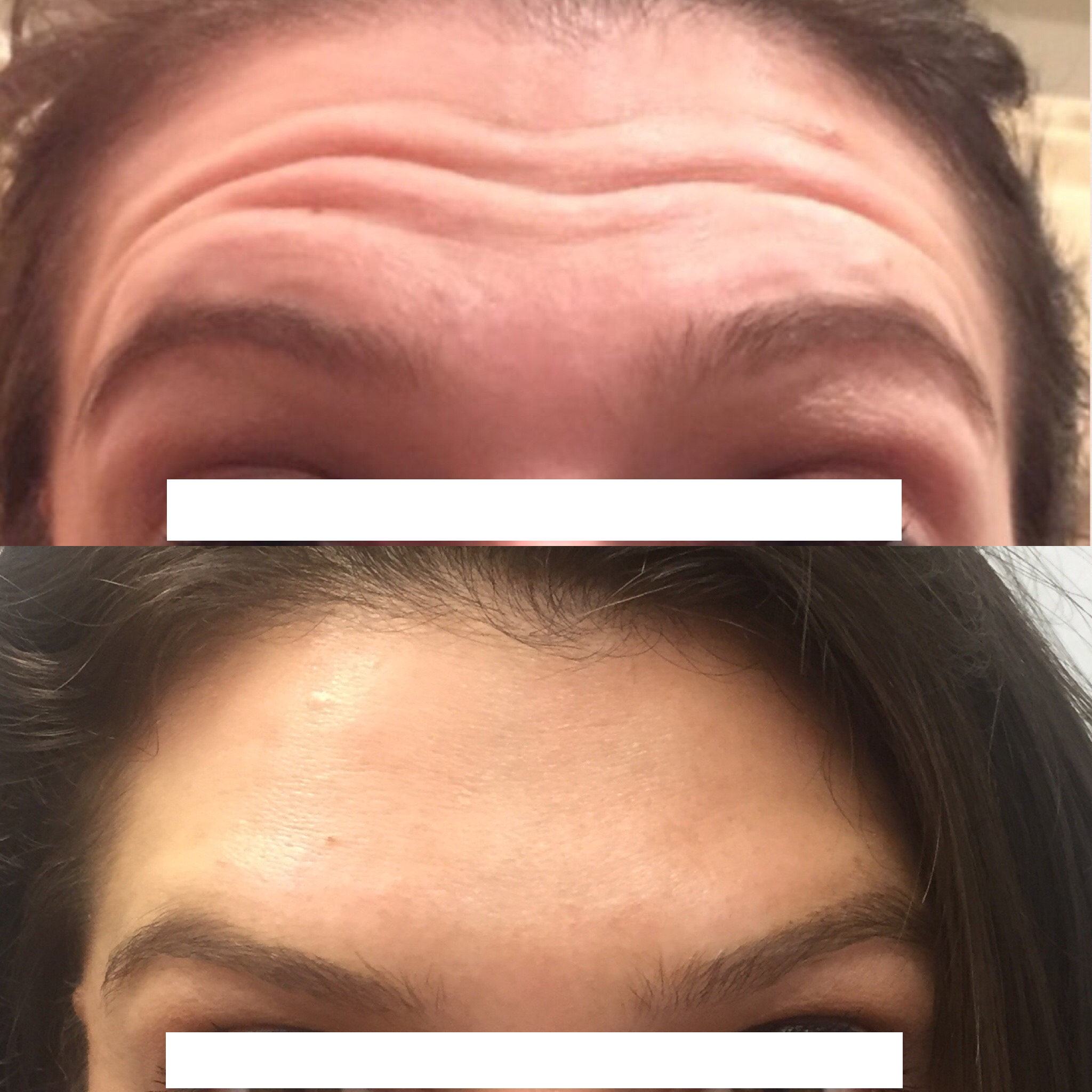 Botox Before and After