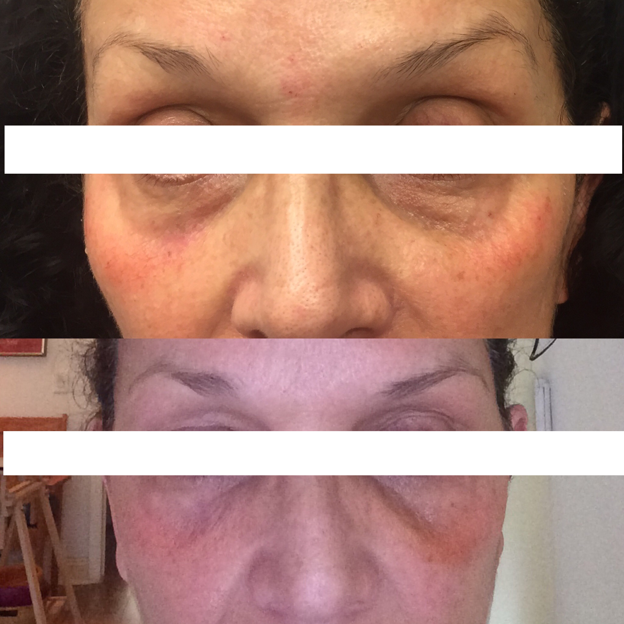 Tear Trough Correction Restylane Silk
