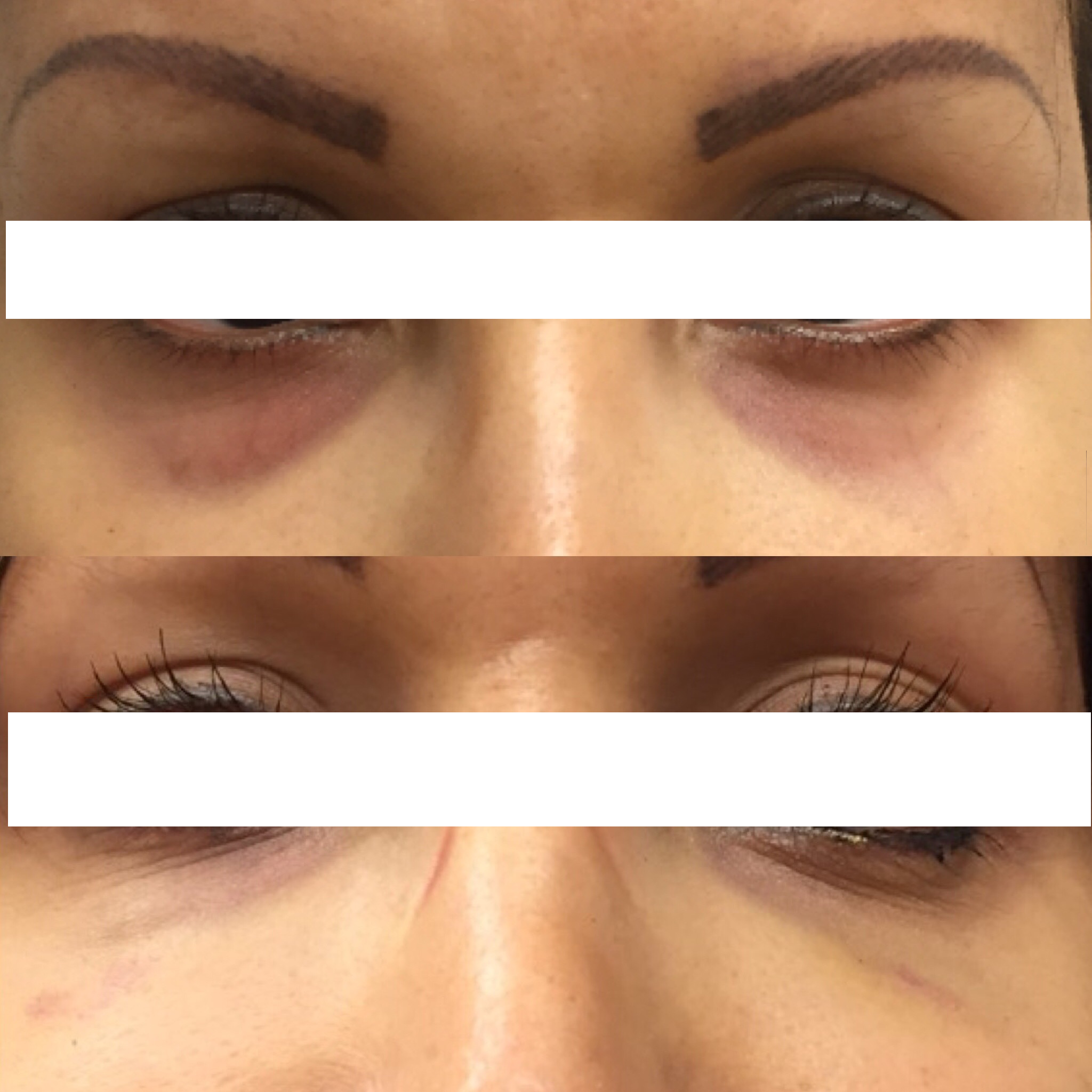 Tear trough filler