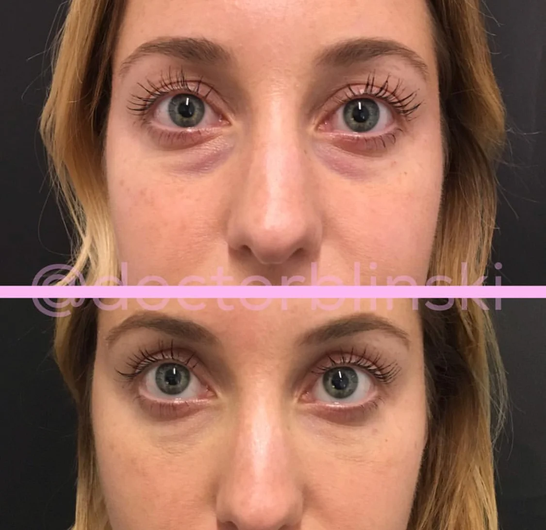 dark under eyes filler