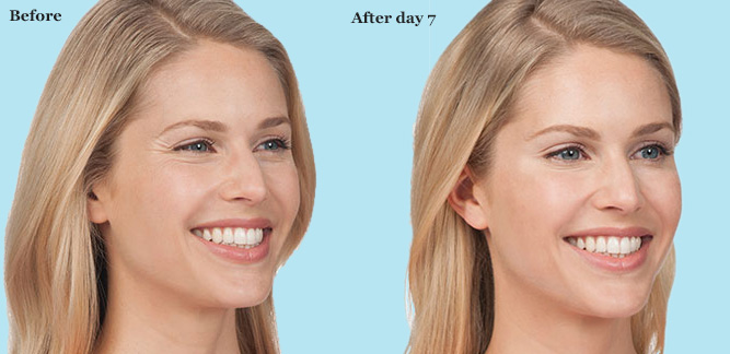 botox results 2