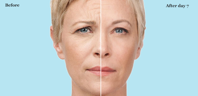 botox results 3