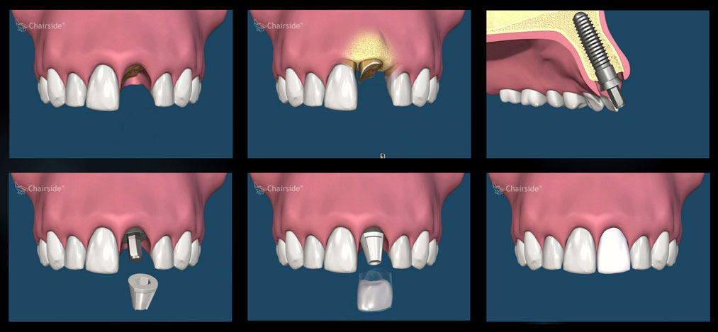 Same Day Tooth Replacement With Dental Implants at Puget Sound Periodontics