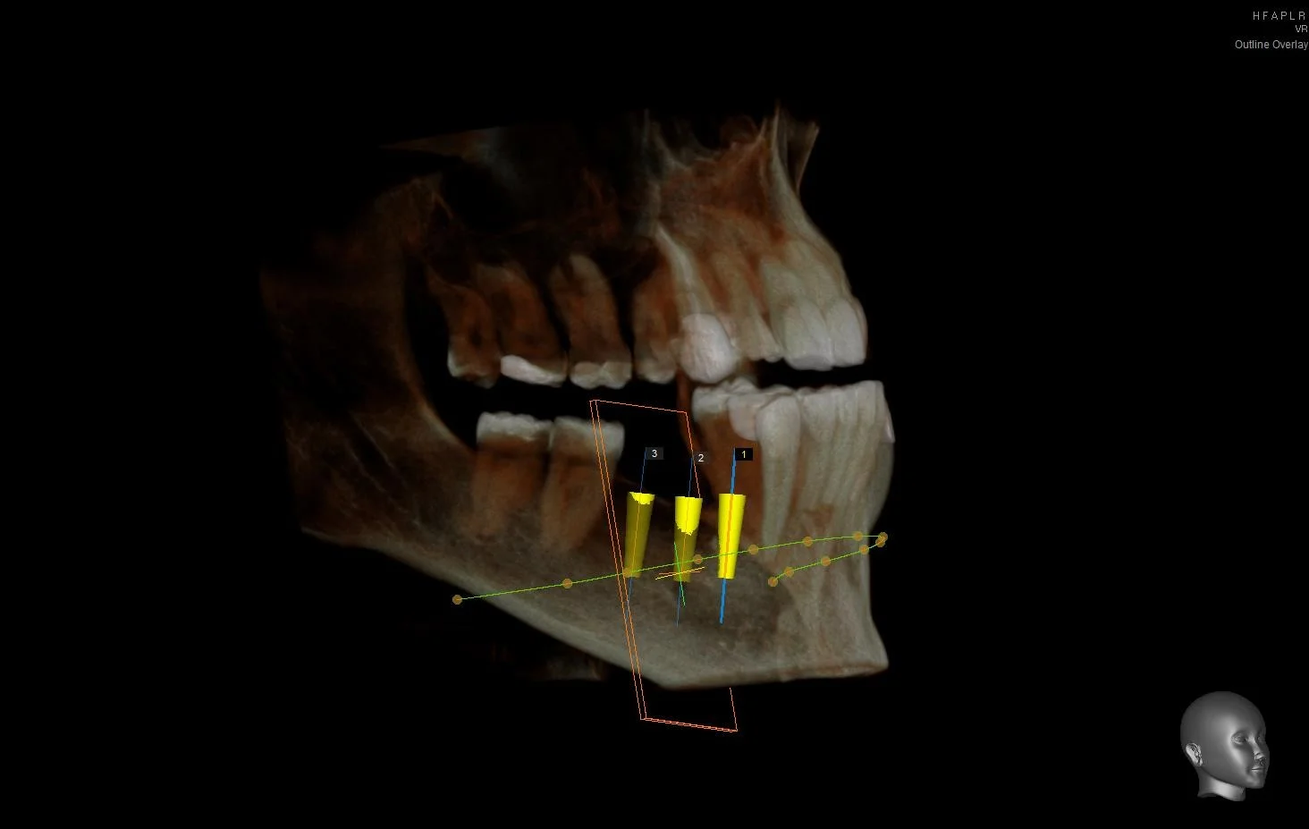 Virtual-Dental-Implant-Planning-Using-Dental-CT-3.jpg