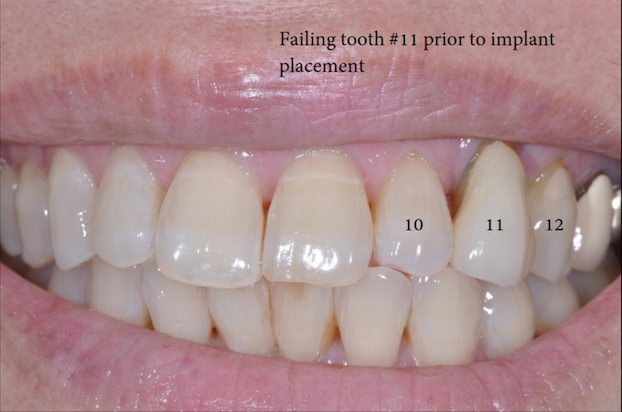 Single Implant Replacement-2.png