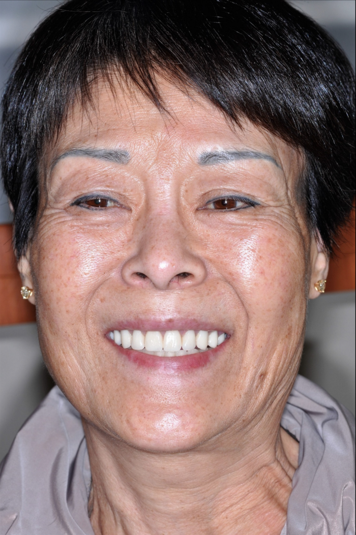 upper and lower implant rehabilitation-4.png