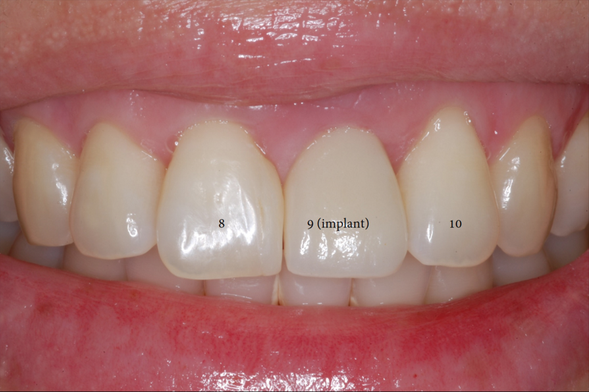 Single Front Tooth Replaced with Implant-2.png