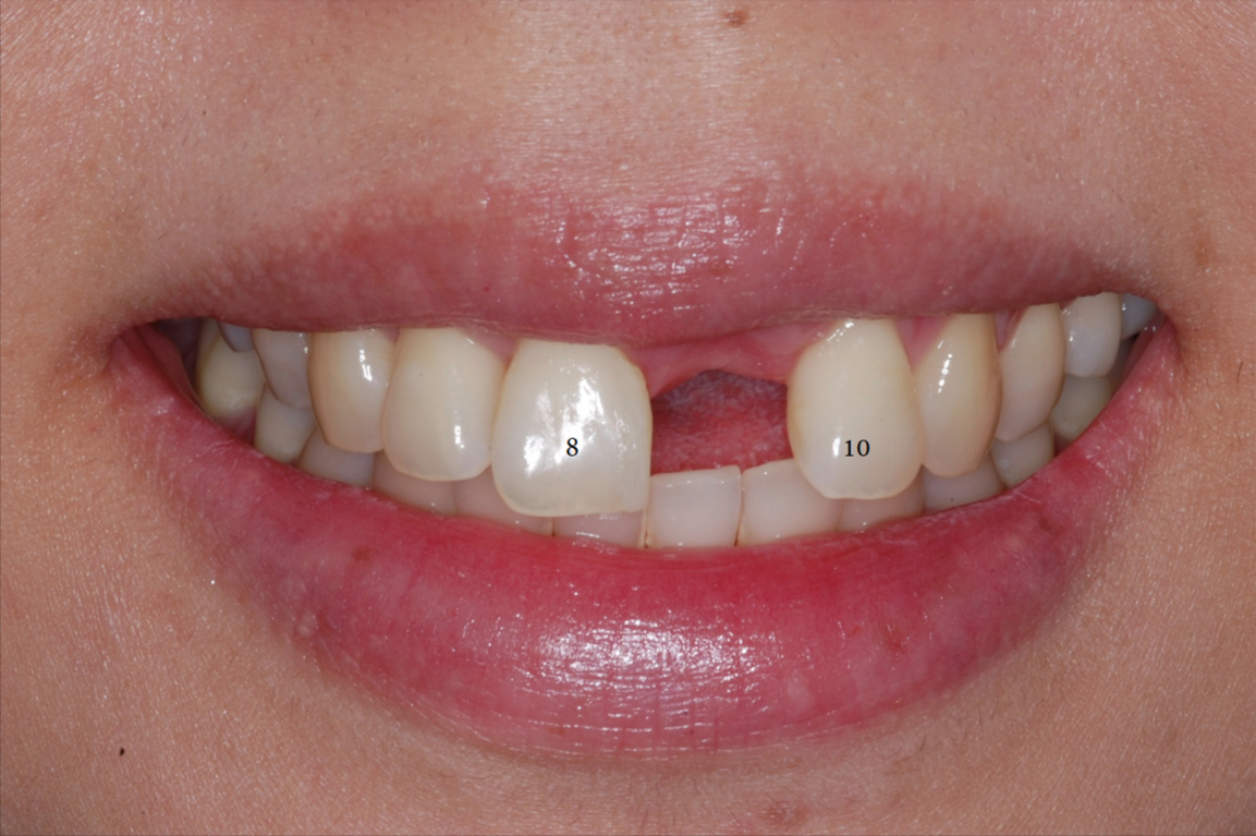 Single Front Tooth Replaced with Implant-3.png