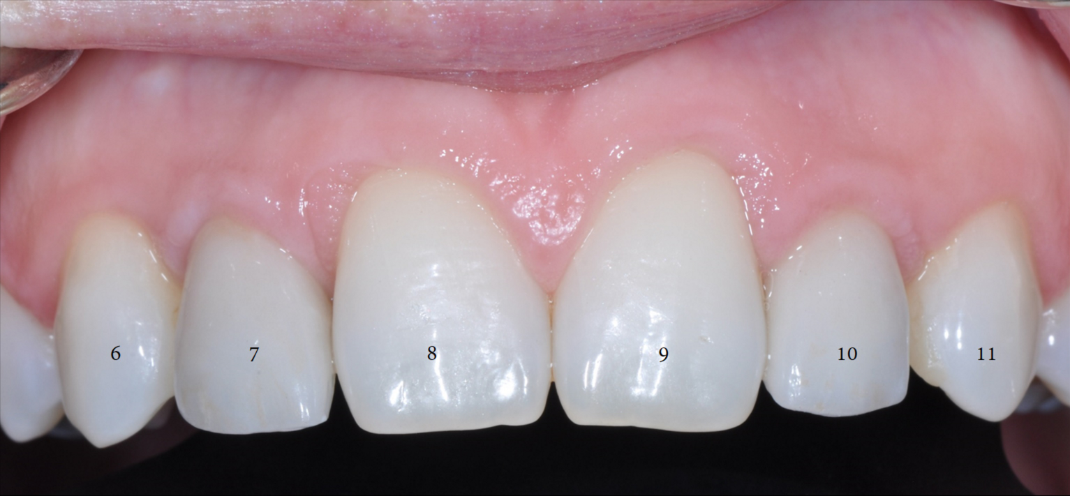 Dental Implant with xrays-2.png