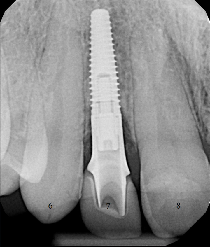 Dental Implant with xrays-3.png