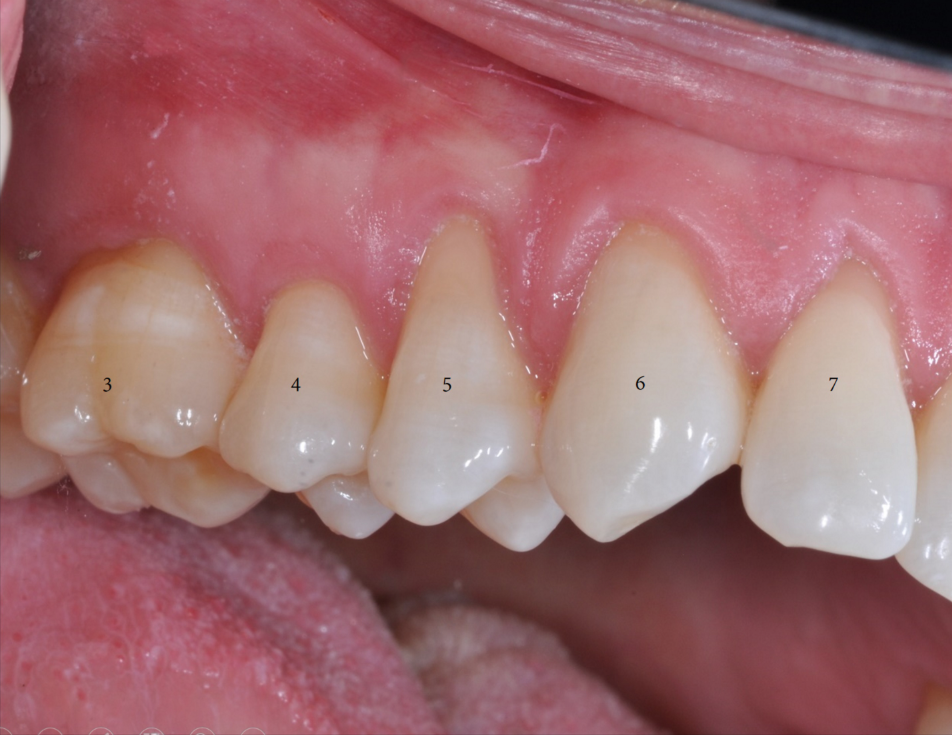 Pinhole Surgical Technique teeth 3-7 12 month follow up-3.png