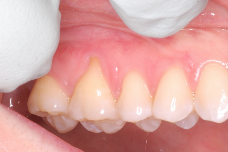 Connective Tissue Graft #3 Before and After-2.png