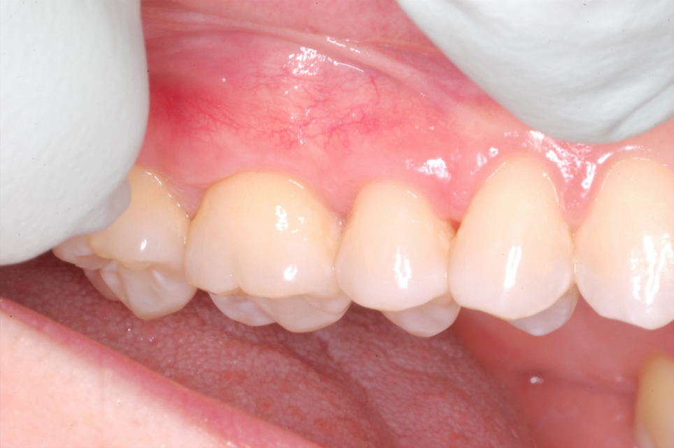 Connective Tissue Graft #3 Before and After-1.png