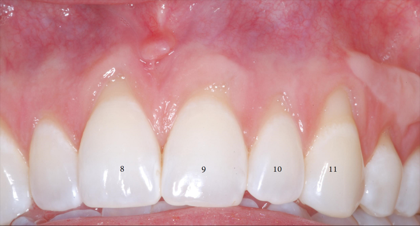 Connective Tissue Graft Before and After 8-11 numbered-3.png