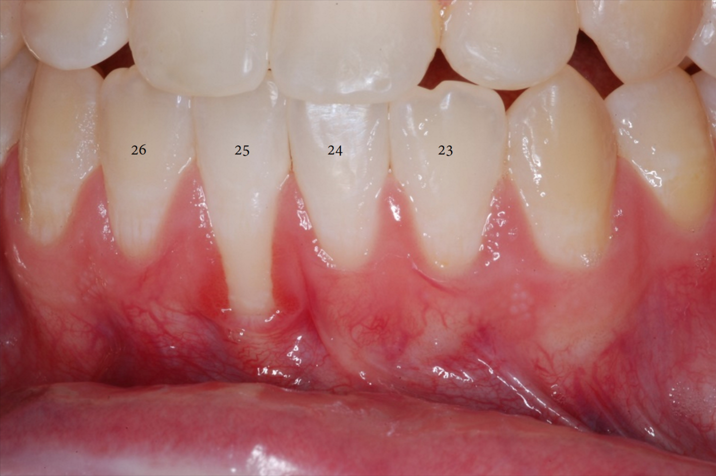 Free Gingival Graft Before and After-3.png