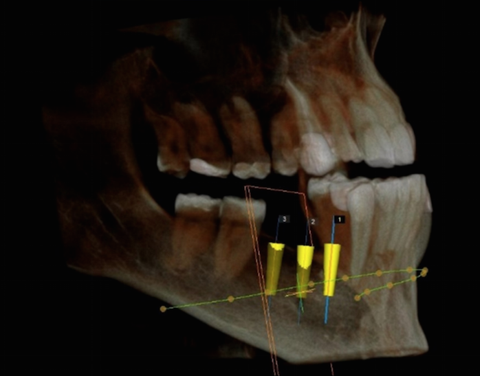 Before and After Bone Graft with Digital Implant Treatment Plan-3.png
