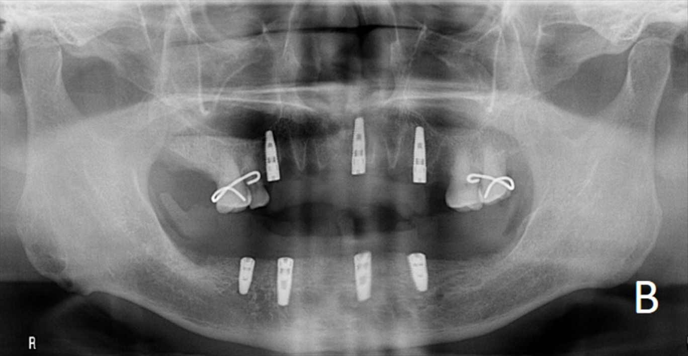 upper and lower overdenture options - b.jpg