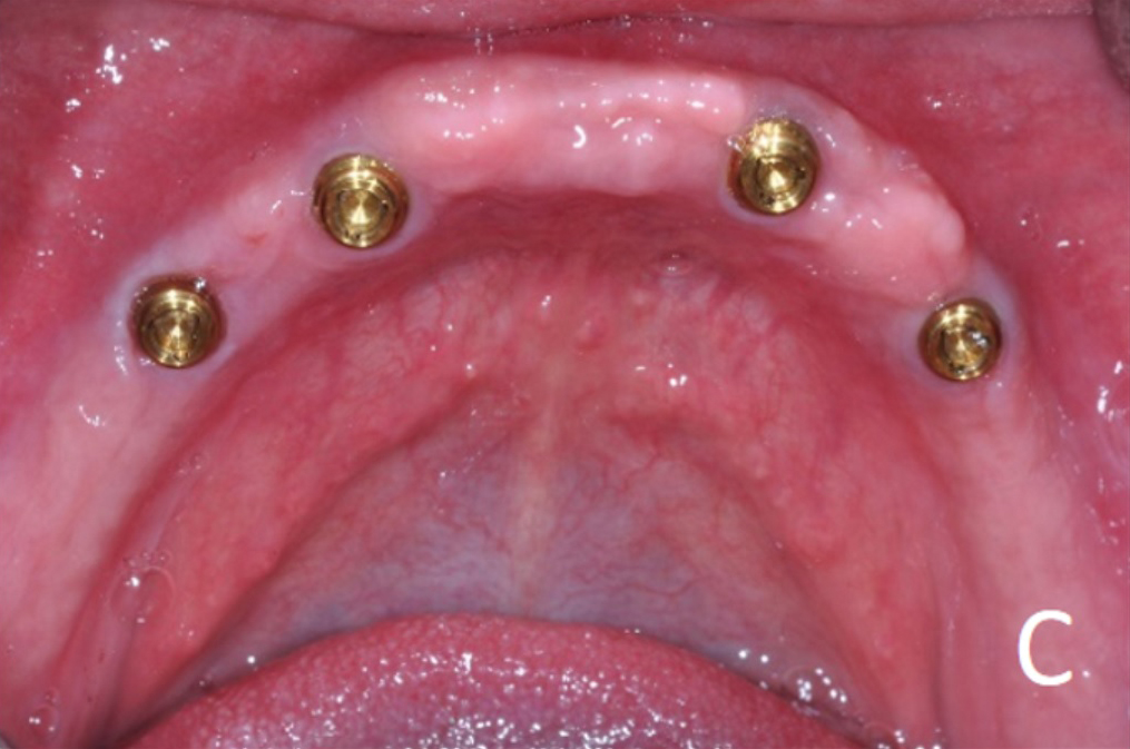 upper and lower overdenture options - c.jpg