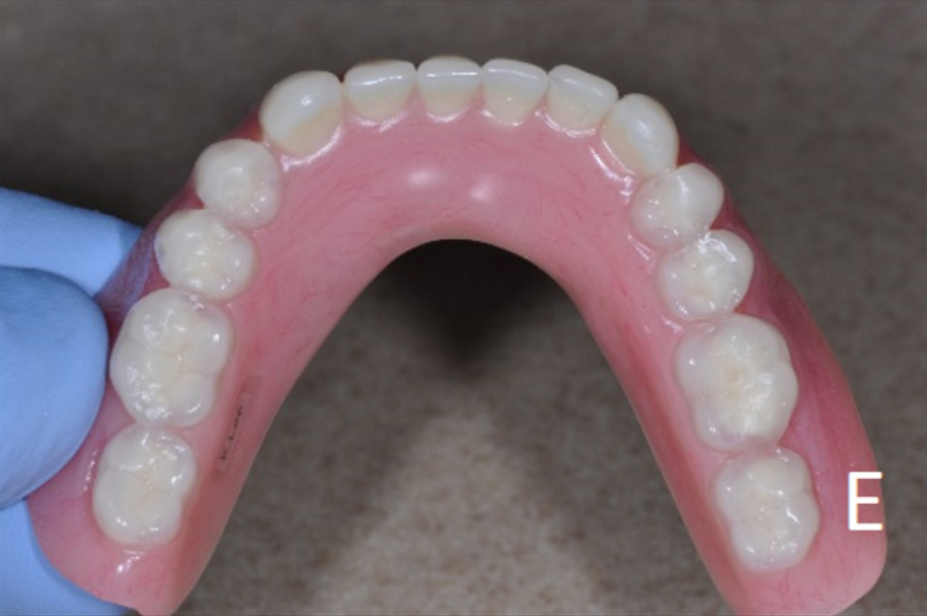 upper and lower overdenture options - e.jpg