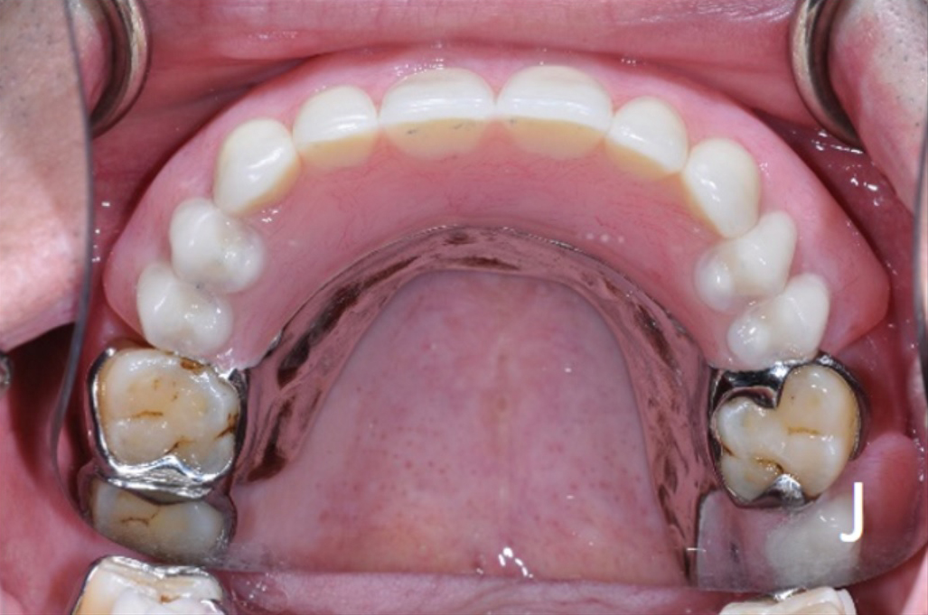upper and lower overdenture options - j.jpg
