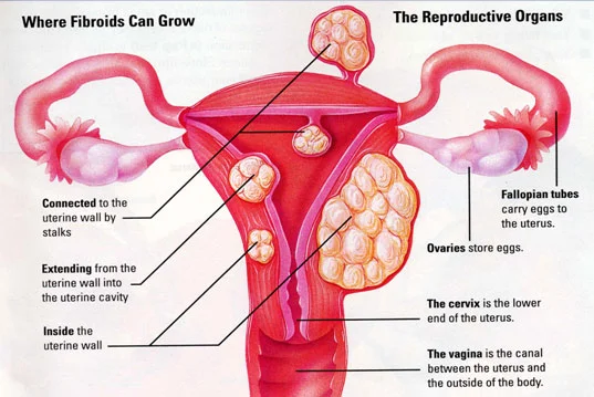 where-fibroids-grow.jpg