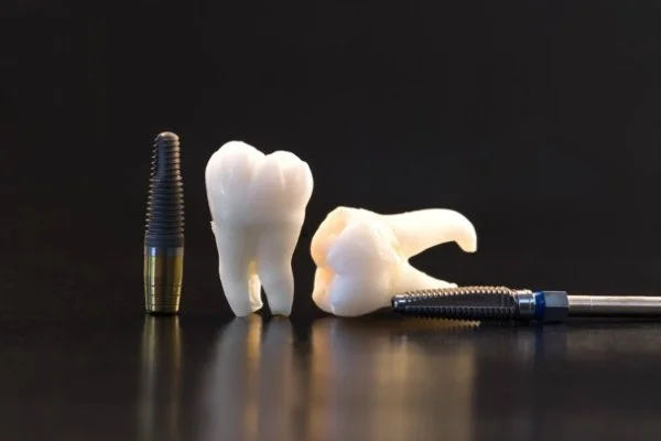 HonestTeeth_implant-restorations.jpg