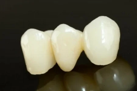 dental bridge 3-min.jpg