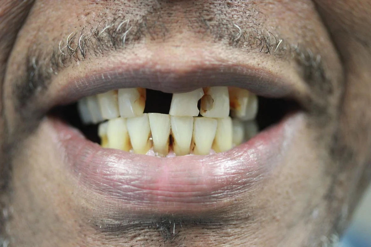 ht-full-mouth-rehab-before.jpg