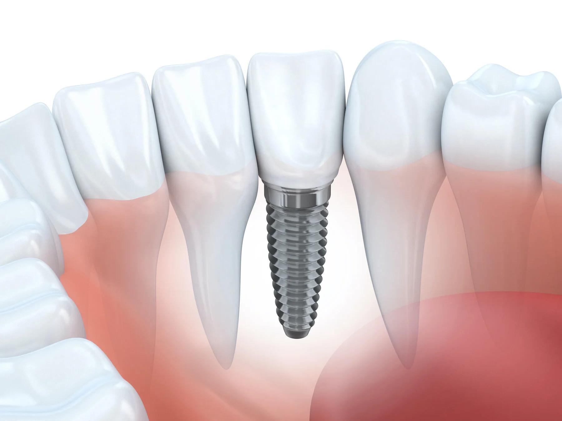 Everything You Need To Know About Your Dental Implant Placement Procedure 