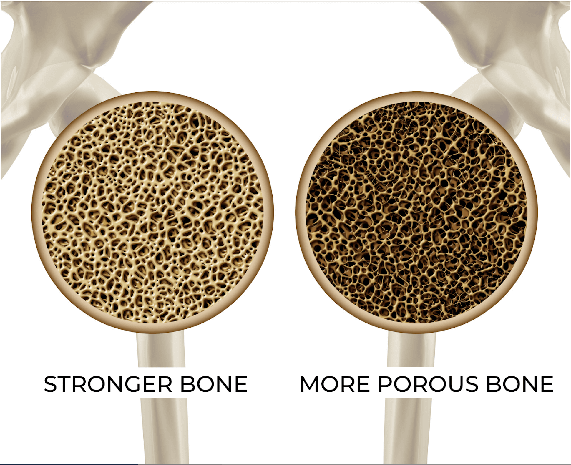 Bone mineral. Bone fragility. К метаболической активности выделяют остеопороз.