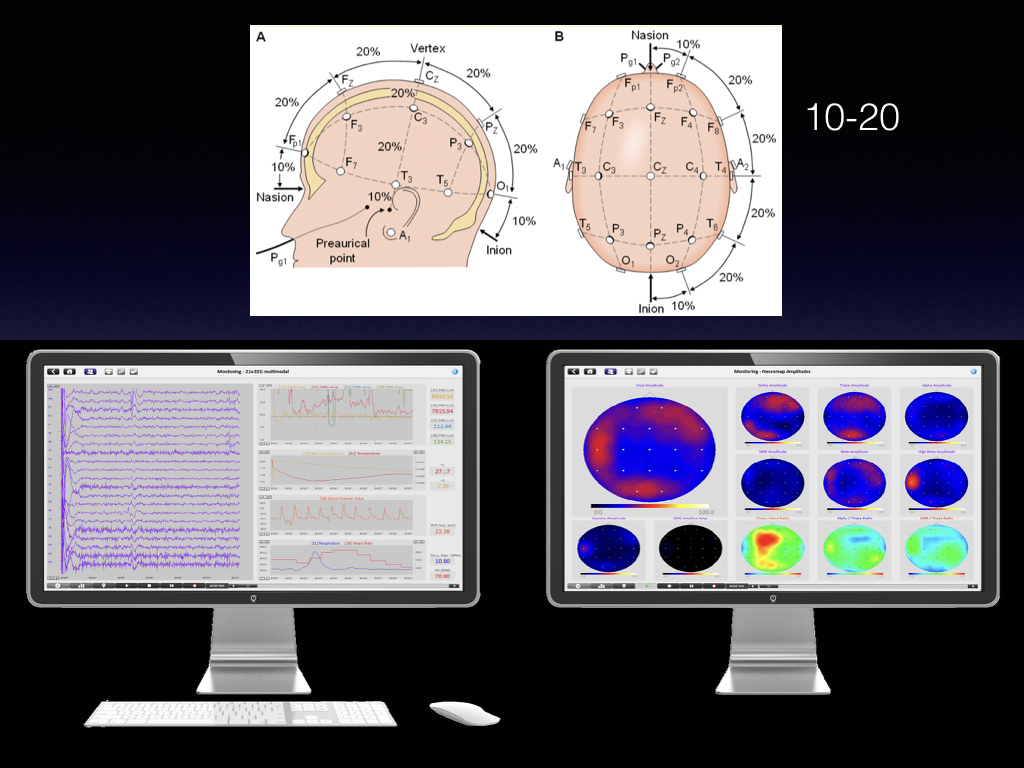 the International 10-20 system and qEEG brain mapping