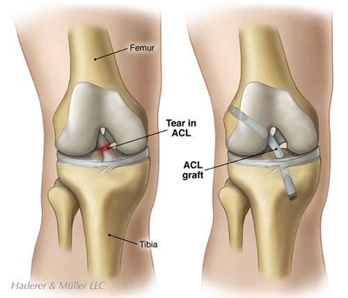 Anterior Cruciate Ligament (ACL) Tear — Southeast Michigan Center for  Orthopedics