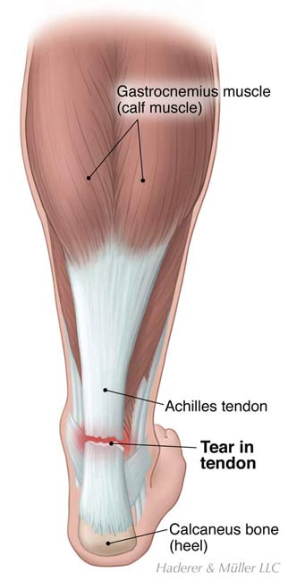 upper achilles tendon pain