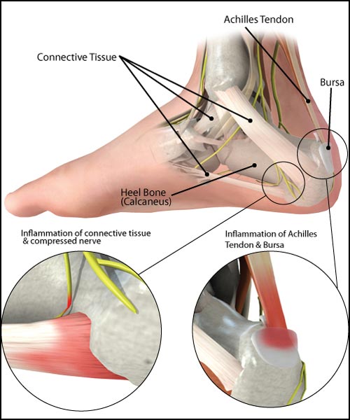 nerve pain in heel