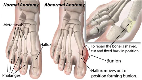 bunions_large.jpg