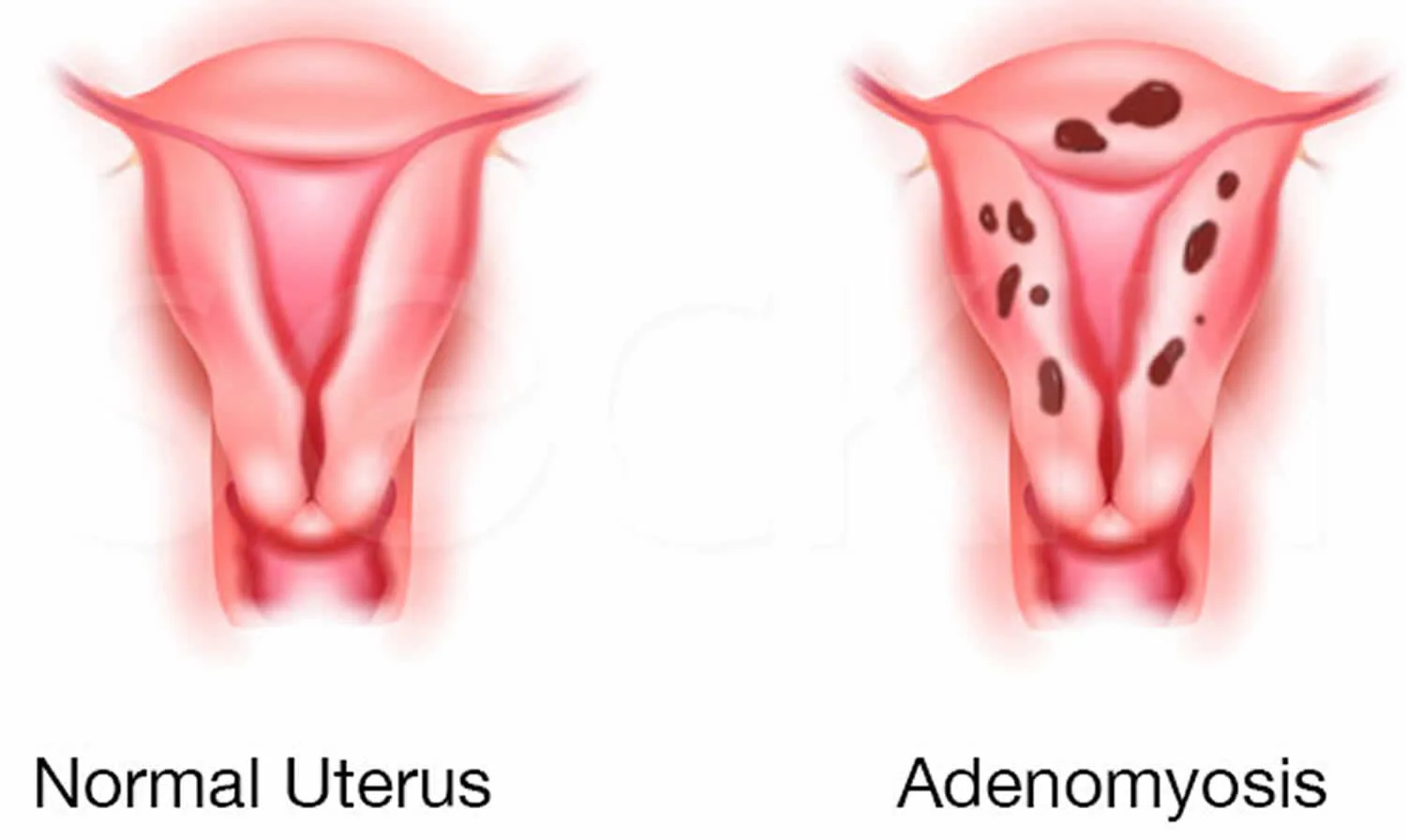 Adenomyosis: Do I have this?