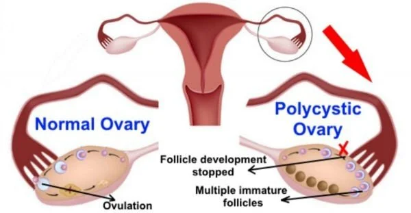 Polycystic Ovary Syndrome (PCOS):  What in the World? (Copy)