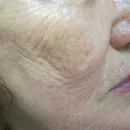 Before Fractora