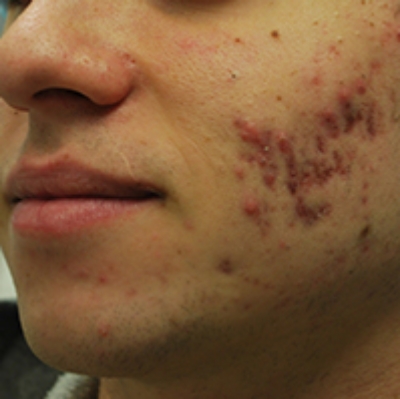 Fractora for Acne