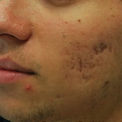 After Fractora Acne Treatments