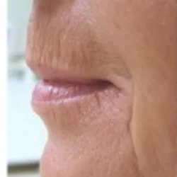 Fractora for Deep lines and Wrinkles