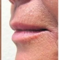 After Fractora Treatment for Wrinkles