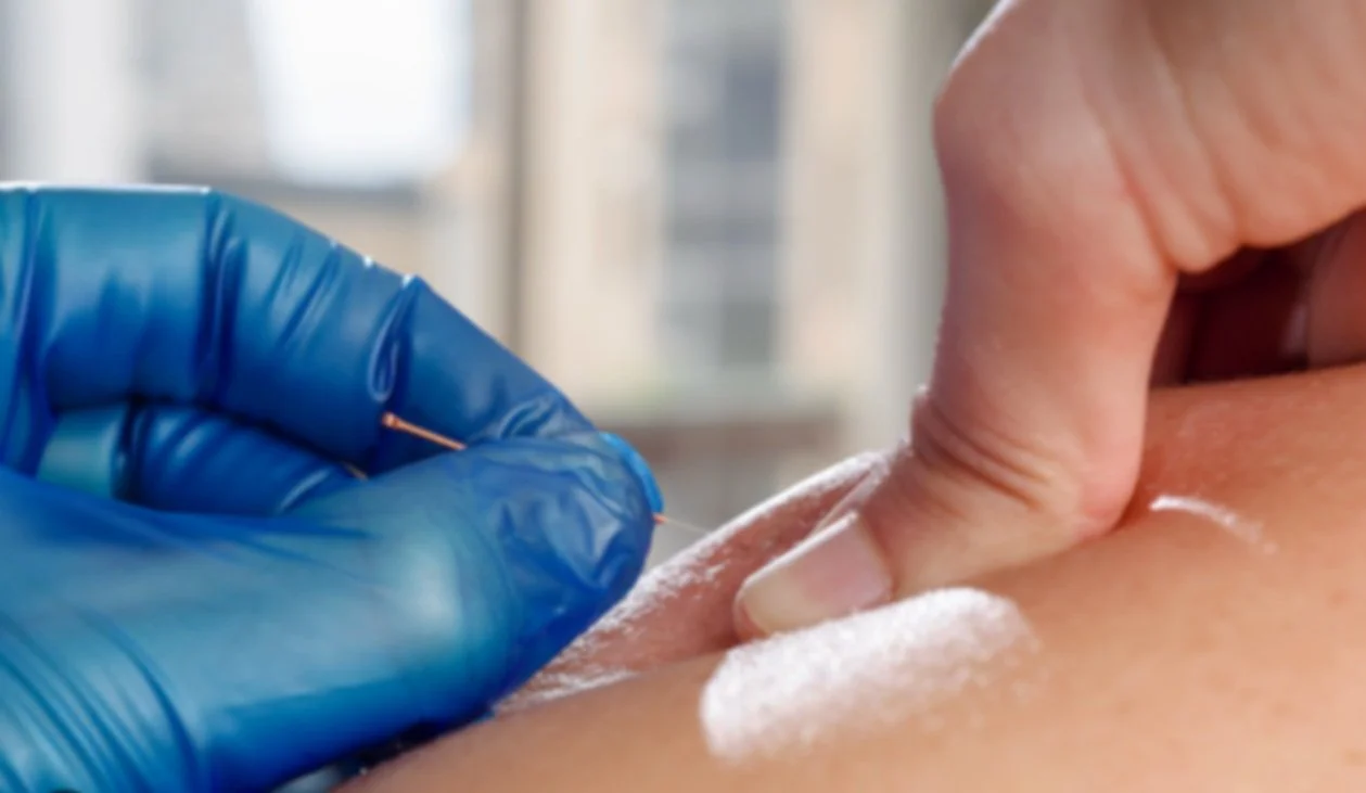 Benefits of Dry Needling and Intramuscular Stimulation