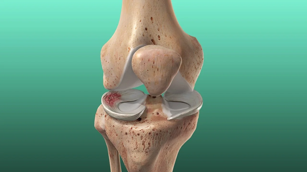 Meniscus Injuries: What Recovery Looks Like
