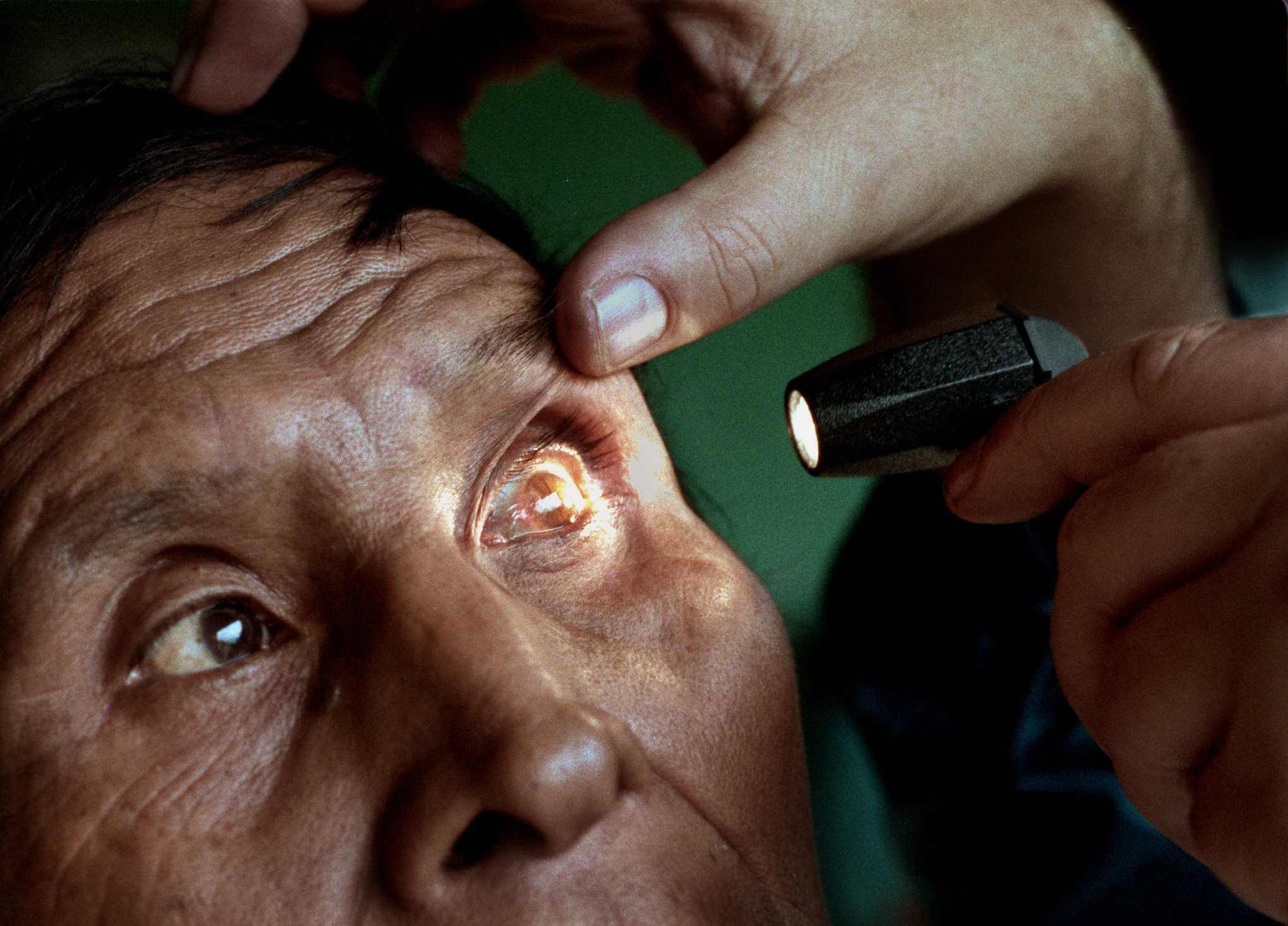 Taylor Bladh, Diamond Bar optometrist, director of Xela Aid optical team, examines another patient as the Mam and Quiche Indians lined up dozens deep in the small mountainous village of San Martin Chiquito. ©Gail Fisher Los Angeles Times